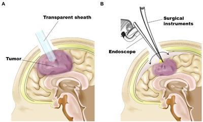 Minimally invasive treatment for glioblastoma through endoscopic surgery including tumor embolization when necessary: a technical note